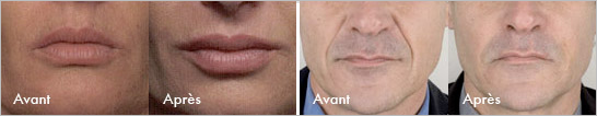 Dermal Fillers